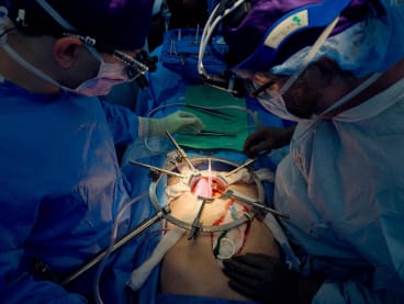 This July 14, 2023, image released by NYU Langone Health in New York, shows a team of surgeons transplanting a pig kidney.